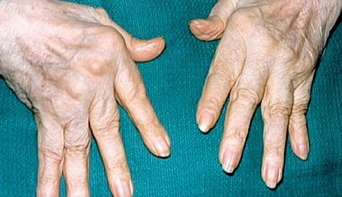 Douleur dans les articulations des doigts