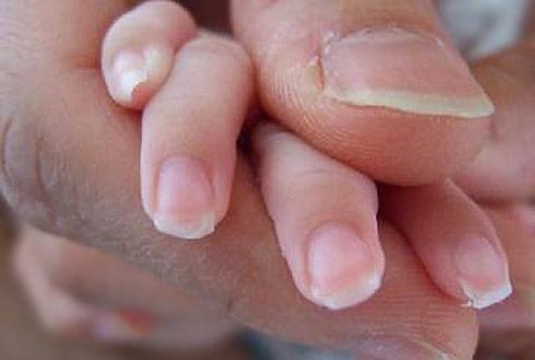 Les ongles sont effilochés, des bandes verticales apparaissent sur la surface