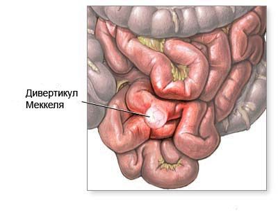 diverticule de Meckel
