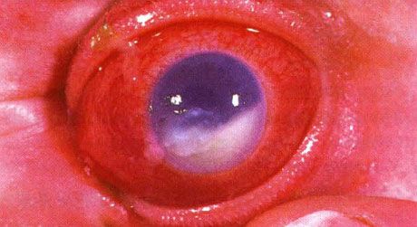 Hypopion accompagnant l'endophtalmie