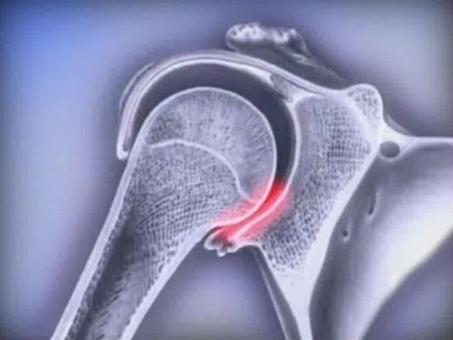 Qu'est-ce qu'une dislocation? 