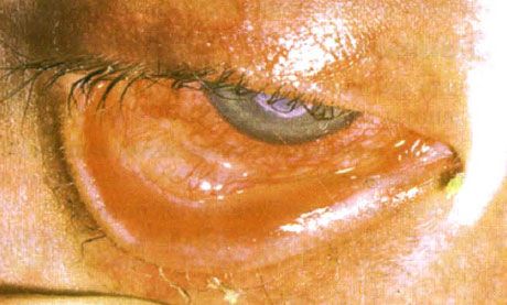 Syndrome de Stevens-Johnson. Conjonctivite desquamative bilatérale avec zones de nécrose. Kératite sévère, provoquant une cicatrisation cornéenne. La situation était compliquée par l'ajout d'un syndrome de l'œil sec.