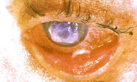 Syndrome de Stevens-Johnson. Conjonctivite desquamative bilatérale avec zones de nécrose. Kératite sévère, provoquant une cicatrisation cornéenne. La situation était compliquée par l'ajout d'un syndrome de l'œil sec.