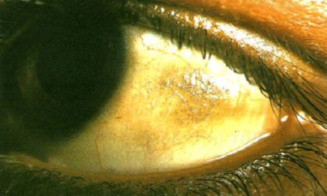 Xérophtalmie. Les plaques de Bitot apparaissent comme des zones surélevées de la conjonctive, avec des dépôts de multiples squames, situées dans la zone non couverte par les paupières. Comme dans ce cas, les zones pathologiques sont souvent pigmentées.