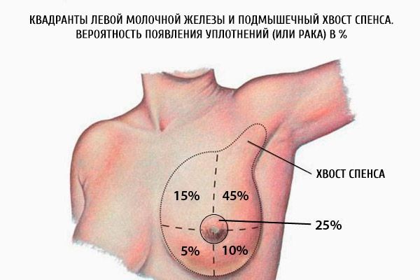 Les quadrants de la poitrine gauche et la flèche axillaire de la stance.  La probabilité de phoques (ou de cancer) en%