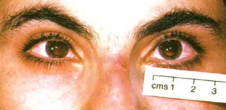 Nanoftaplm. Les yeux sont de taille réduite.