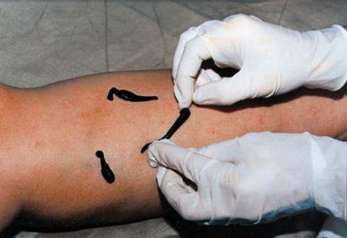 Sangsues contre les varices