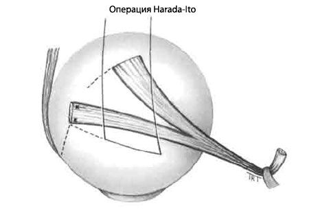 Strabisme - Opération