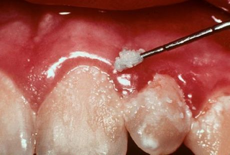 Dents et gingivite