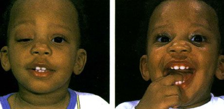 Ptosis unilatéral sévère avec absence du pli palpébral supérieur de l'œil droit.