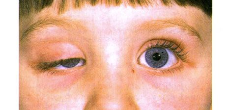 Ptosis congénital unilatéral