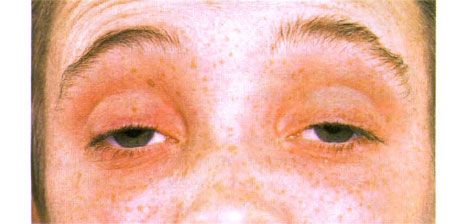 Ophtalmoplégie externe. Ptosis bilatéral. Le patient ouvre les yeux en levant les sourcils.