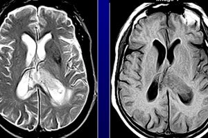 astrocytomes du cerveau chez un enfant symptomes traitement