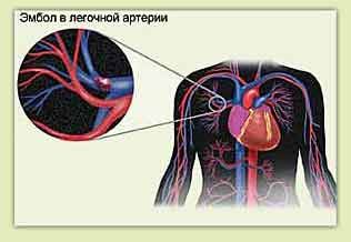 Embolie pulmonaire et douleurs thoraciques à gauche