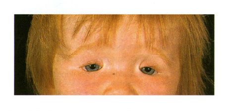 Colobome recto-verso des paupières chez un enfant atteint du syndrome de Golden.  Fermeture de la fente oculaire à gauche